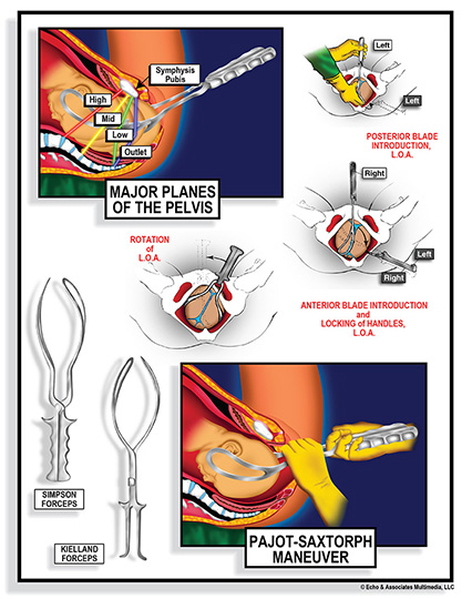 Pelvic Birthing Canal Diagram